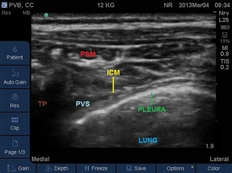 Identify the pleura beneath (Fig 10). For the best view and a successful block you should ensure ...