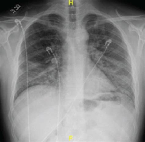 Initial chest X-ray showing bilateral patchy infiltrates with lower... | Download Scientific Diagram