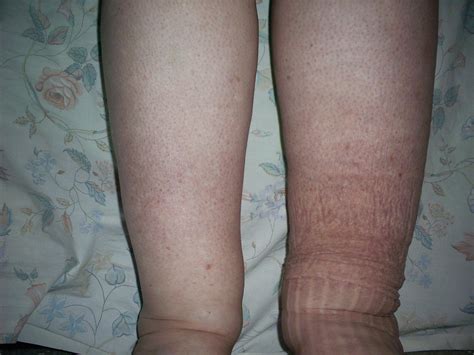 What is Lymphedema