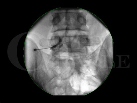 Lumbar nerve root block Surgical Technique - OrthOracle