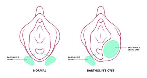 Bartholin’s Cyst – Causes, Symptoms and Removal | Andrew Krinsky, MD, FACOG