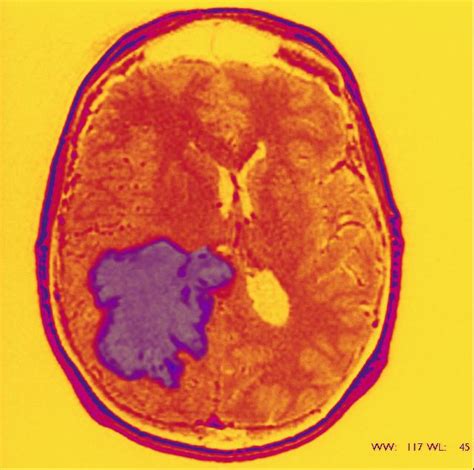 The ‘Miracle’ Glioblastoma Treatment | Shareable Snippets