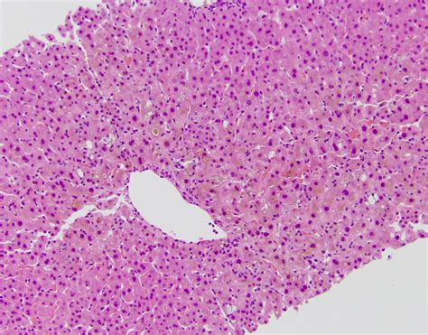 liver pathology – Blog | PathologyOutlines.com