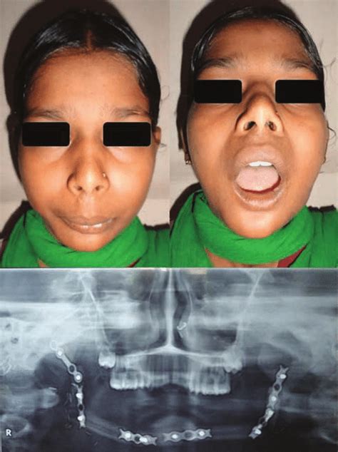 Postoperative results after ramus to ramus reconstruction. | Download ...