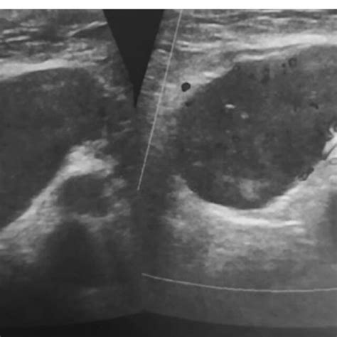 Ultrasound of right axilla: Enlarged malignant looking lymph nodes in... | Download Scientific ...