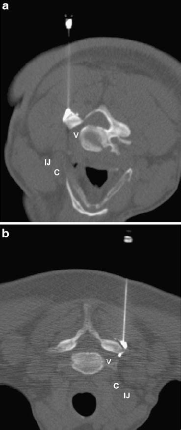 Indirect cervical nerve root injection. a The needle and contrast... | Download Scientific Diagram