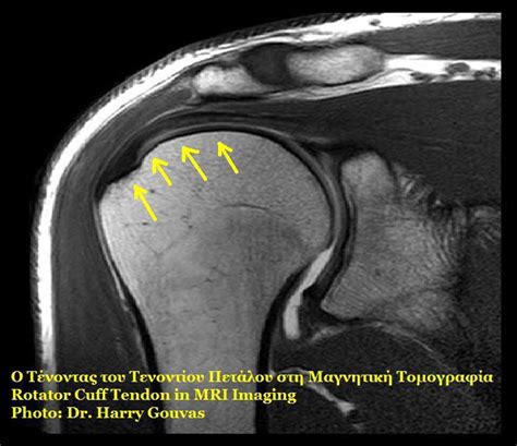 Rotator cuff symptoms | General center | SteadyHealth.com