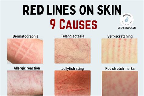 Red Lines on the Skin: 9 Causes, Pictures & Treatment