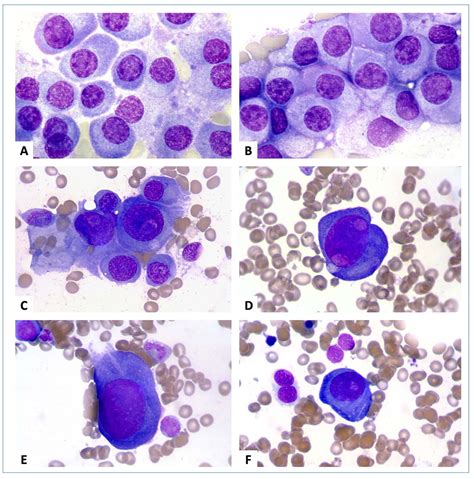 Images from the Haematologica Atlas of Hematologic Cytology: plasma cell myeloma | Haematologica ...