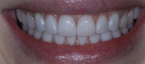 Transforming Smiles with Full Mouth Veneers and Crowns - Pickett Family Dental