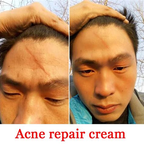 Scar Repair Skin Essential Oil Skin Care Natural Pure Remove Burn Scar Removal Scald Skin Repair ...