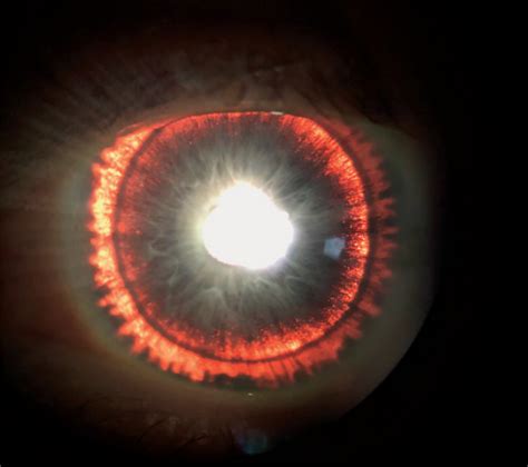 Man's 'Glowing' Iris Was a Sign of Rare Eye Syndrome | Live Science