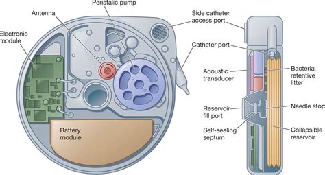 Commercially Available Reservoir Options for Intrathecal Drug Delivery ...