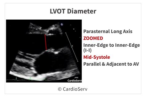 Back to the Basics: Aortic Valve Anatomy Cardioserv