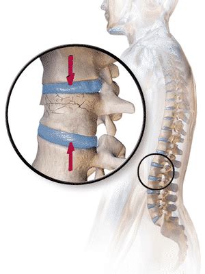 An Overview Of Bone Cement Used In Spine | Spine Surgeon