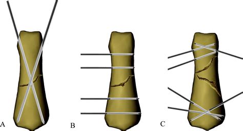 Cemented K-wire fixation for the treatment of shaft fractures of middle ...