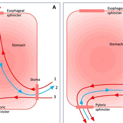 PEG-J replacement procedures: "pull" and "push" methods comparison | Download Scientific Diagram