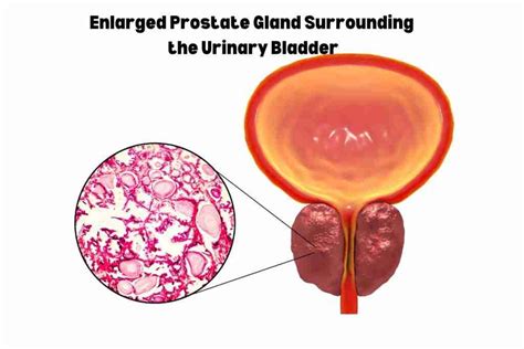 Benign Prostatic Hyperplasia: Symptoms, Causes, Diagnosis, and Treatment