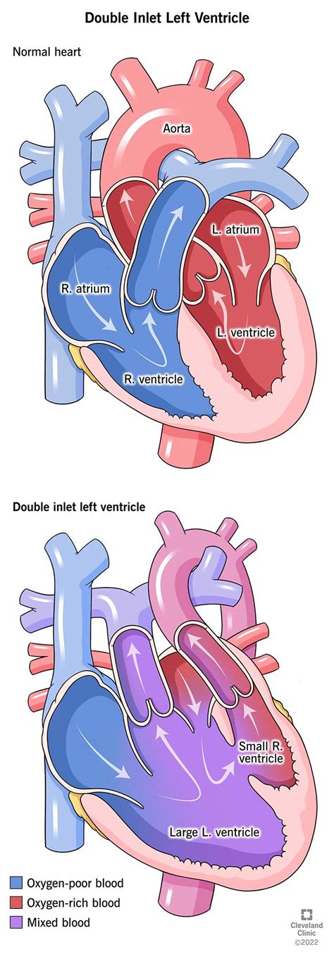 Double Inlet Left Ventricle: Surgery, Treatment & Prognosis