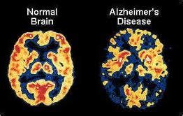 NeuroQuant® Dementia Imaging CT | Midstate Radiology