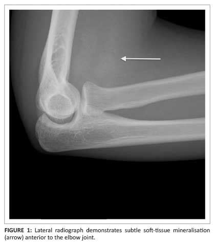 MYOSITIS OSSIFICANS - New