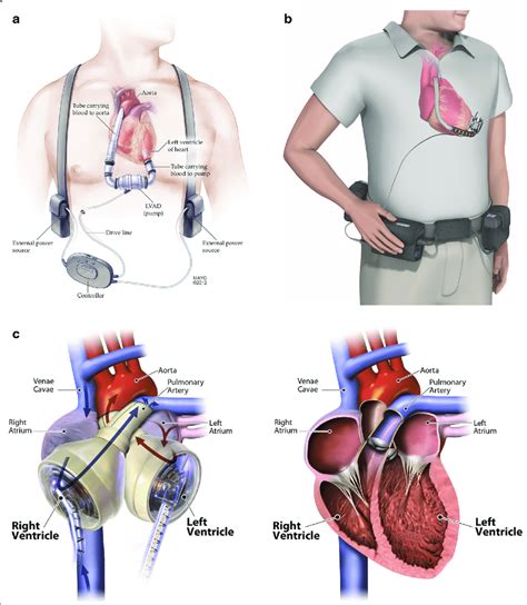 Most commonly used mechanical circulatory support devices. a The... | Download Scientific Diagram