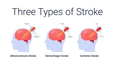 Premium Vector | Ischemic stroke diseases stage anatomy diagram vector ...