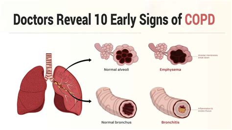 Symptoms Of Copd