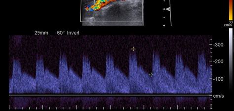 Whooshing in Ear: What is it? What are the Treatments?