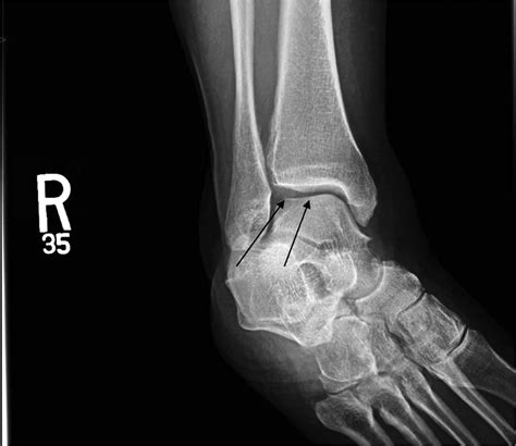 Peroneus Tertius Tendon