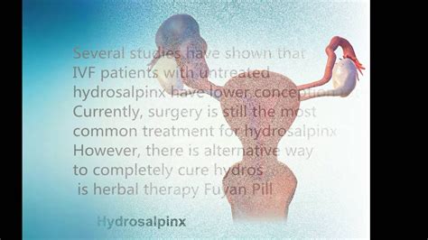 how to cure hydrosalpinx without surgery - YouTube