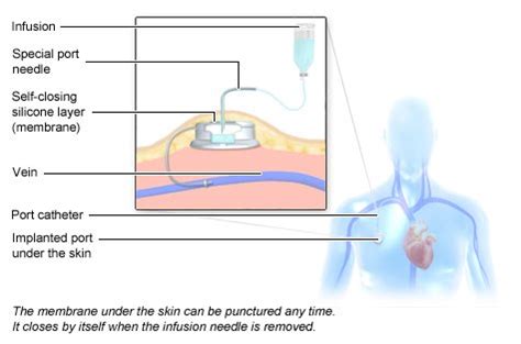 How does chemotherapy work? | informedhealth.org