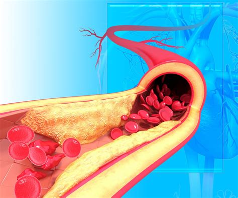 Aterosclerosis aórtica: síntomas y tratamiento