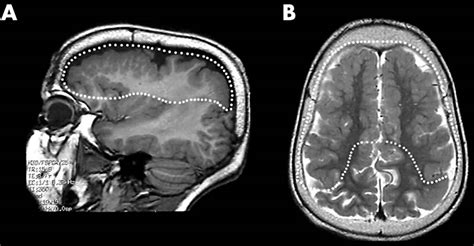 Polymicrogyria causes, symptoms, diagnosis, treatment & prognosis