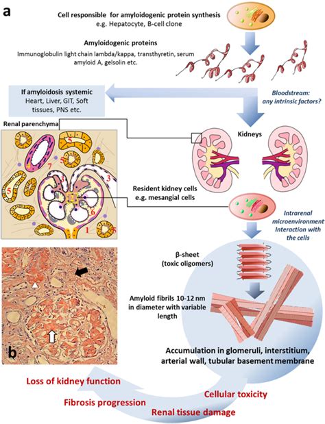 IJMS | Free Full-Text | Noninvasive Diagnostics of Renal Amyloidosis ...