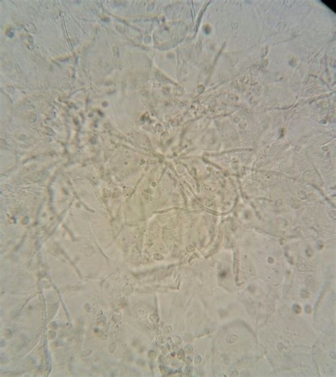 Fungi in the urine test (GUE) | Medical laboratory, Medical laboratory ...