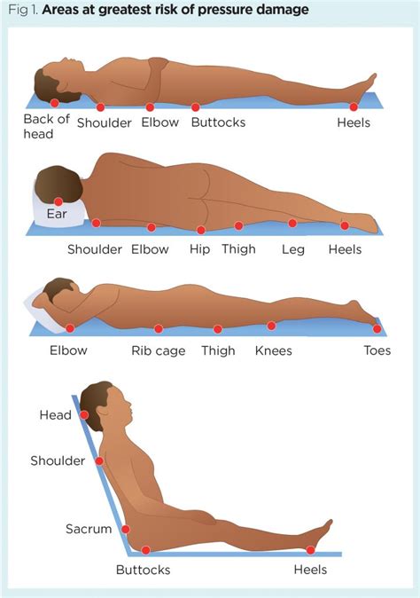 Pressure Ulcer Risk Areas