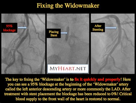 Widowmaker Heart Attack Explained by Cardiologist • MyHeart