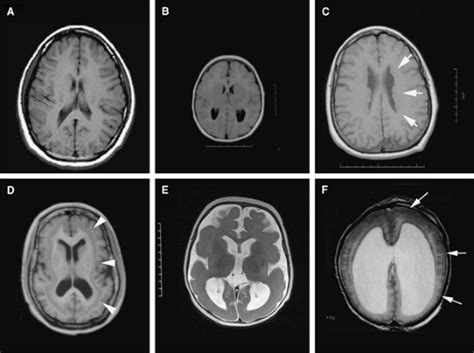 Early Events in the Development of the Cerebral Cortex | Neupsy Key