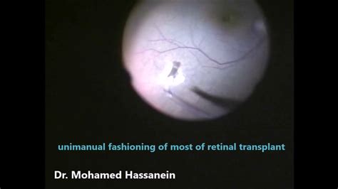 An escaping retinal transplant - YouTube