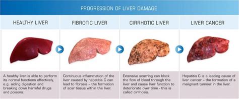 Risk, Prevention & Screening of Liver cancer