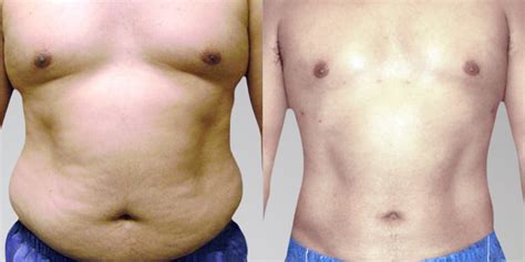 Men Before and After Stomach Liposuction | Sono Bello