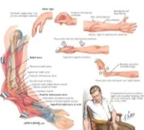 Radial Nerve Compression