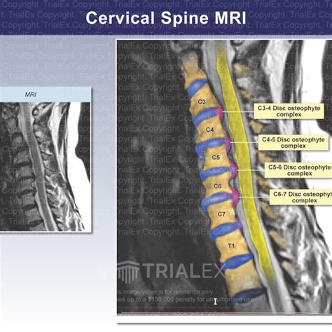 Cervical Spine MRI: Osteophytes - Trial Exhibits Inc.