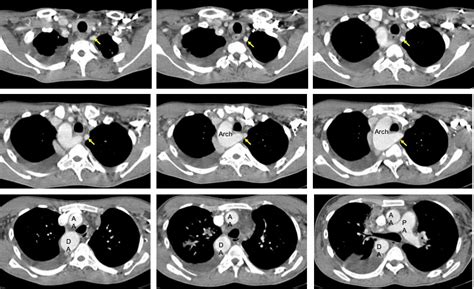 Right sided aortic arch with aberrant left subclavian artery – Radiology Cases