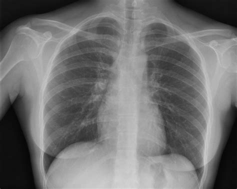 Hodgkin’s Lymphoma Presenting as Chest Pain