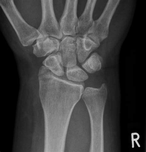 An intra-articular fracture of the radial styloid process is demonstrated, involving only the ...