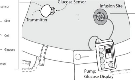 Insulin Pumps and CGM