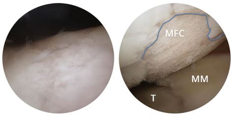 Melbourne Arthroplasty | Articular Cartilage Injury