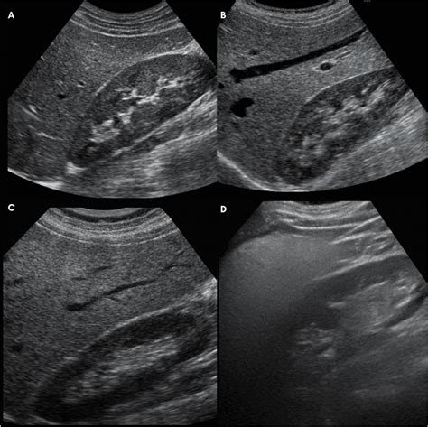 Understanding Fatty Liver Ultrasound Grading | Fatty Liver Guide